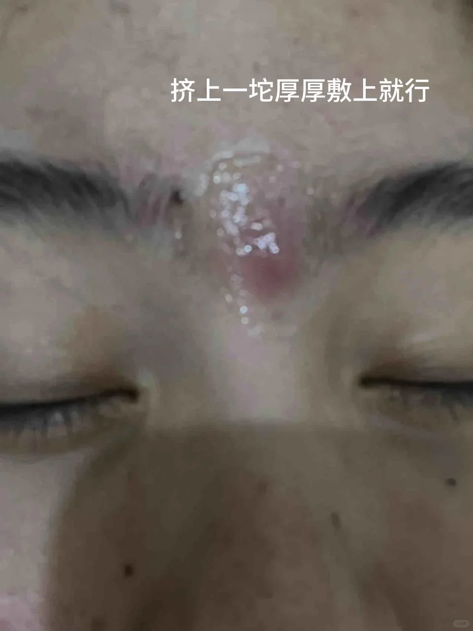 长红肿痘痘太难了