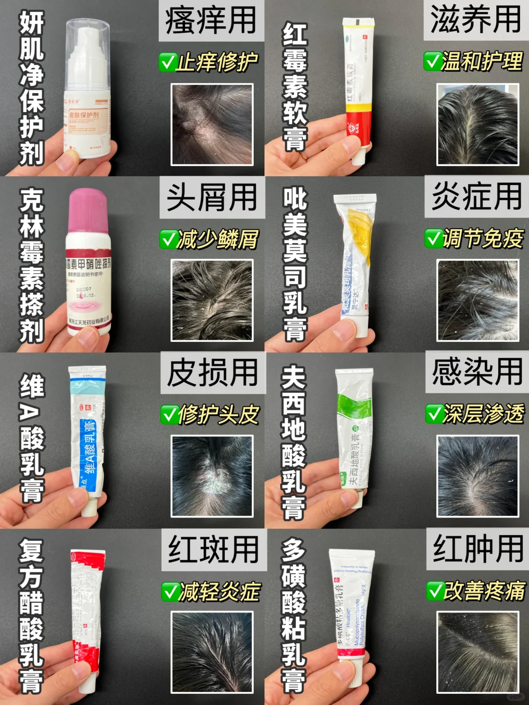 脂溢性头皮炎涂什么药膏？一次选对❗