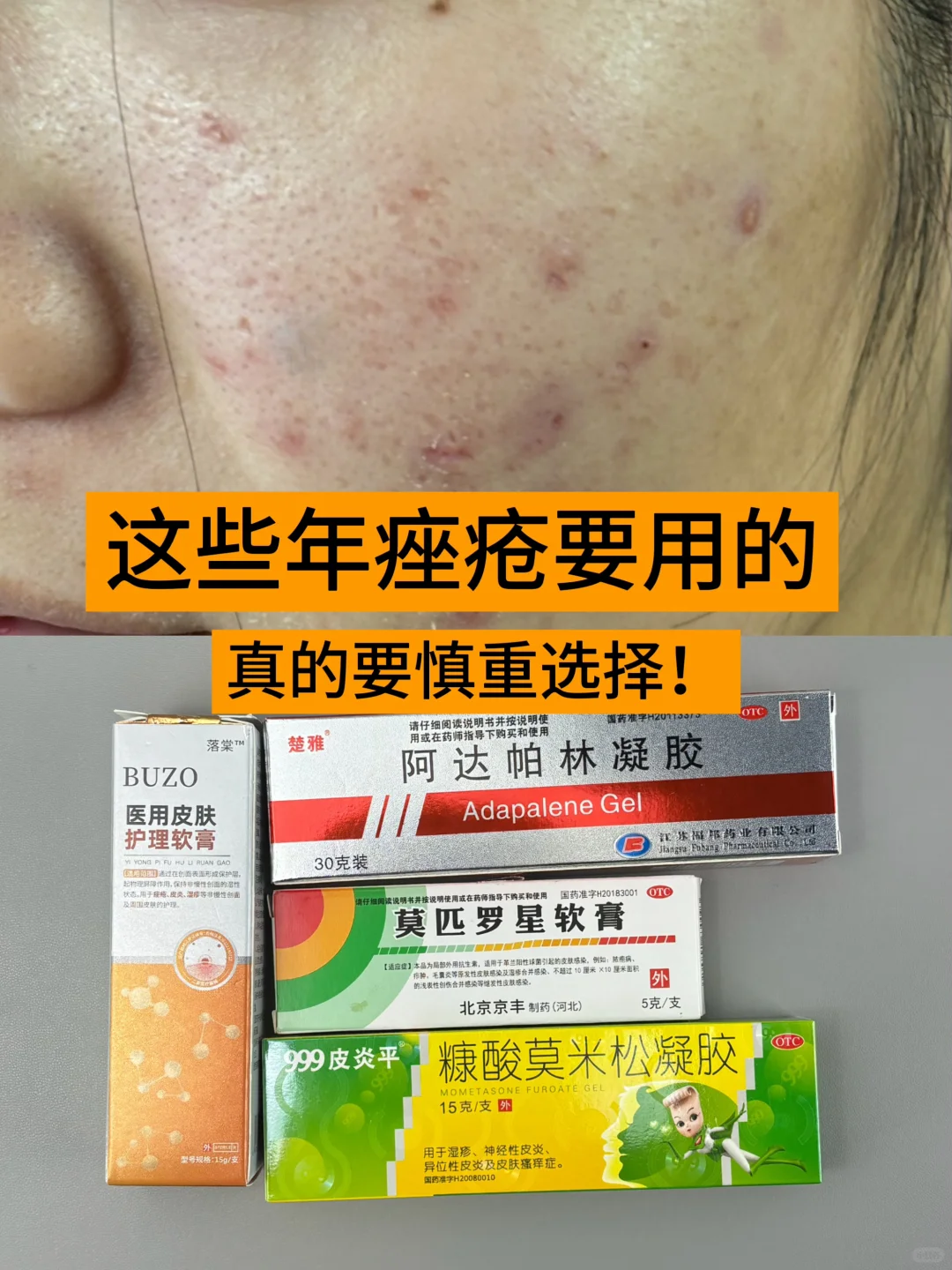 真心劝大家，痤疮膏别乱用！！
