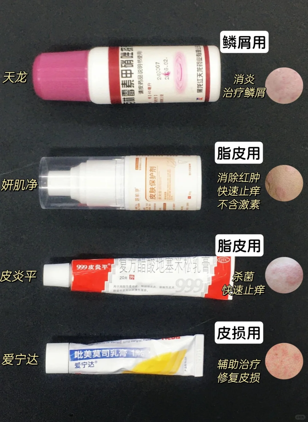 脂溢性头皮炎，说点头皮炎大实话‼